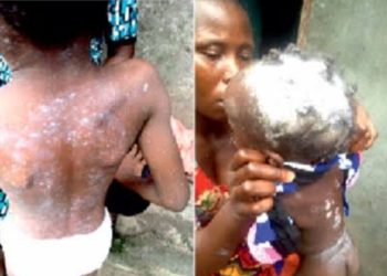 Low Immunization, Waning Immunity Among Causes Of Measles Outbreak In Nigeria – UNICEF