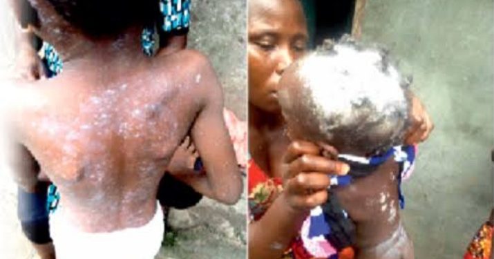 Low Immunization, Waning Immunity Among Causes Of Measles Outbreak In Nigeria – UNICEF